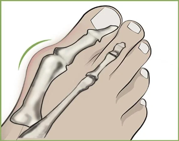 Hallux Valgus Zehenspreizer - 3
